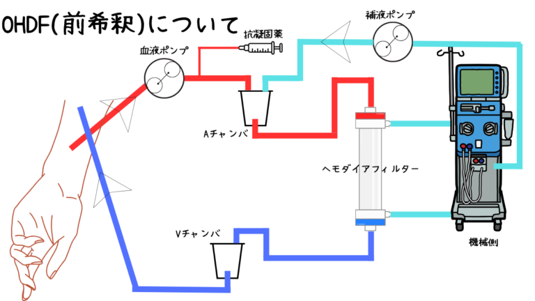 HD vs OHDF vs I-HDF：臨床工学技士が知っておくべき違いとポイント | みんなのMEセンター