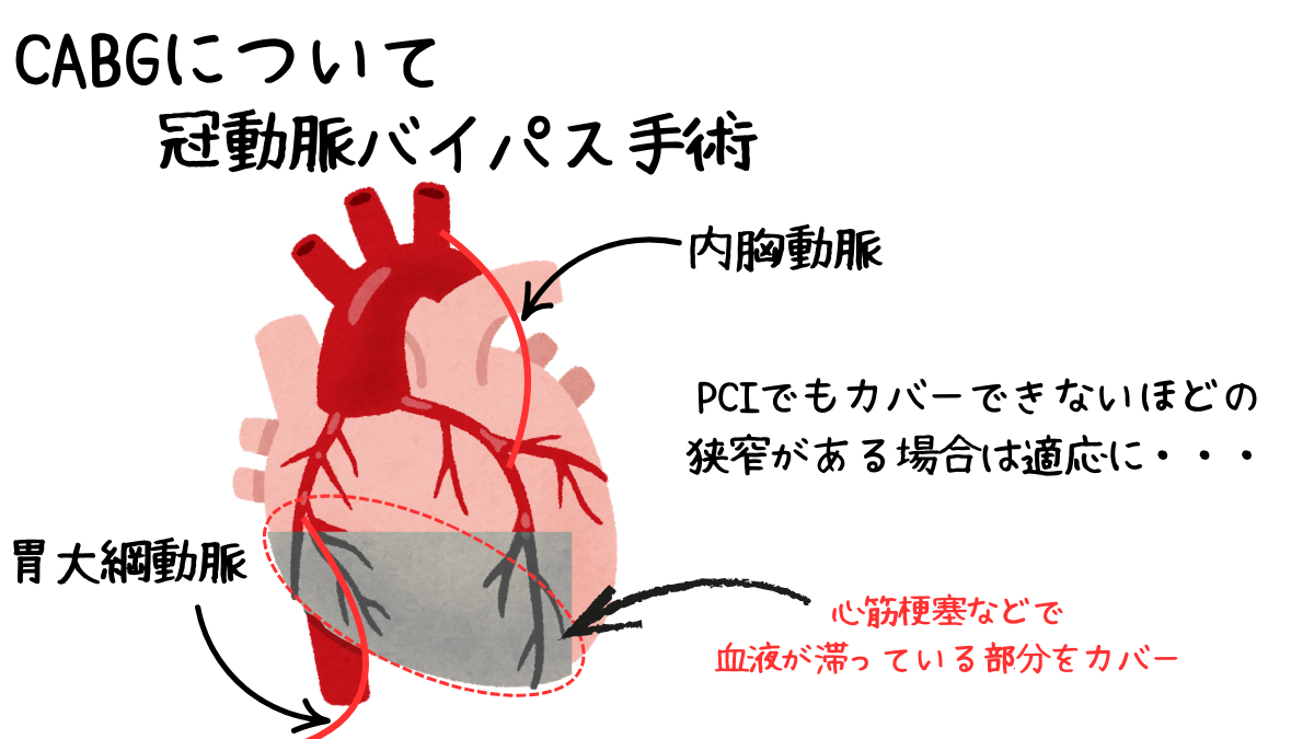 臨床工学技士が知るべきCABGの基礎と実践：PCIとの違いを徹底解説 | みんなのMEセンター
